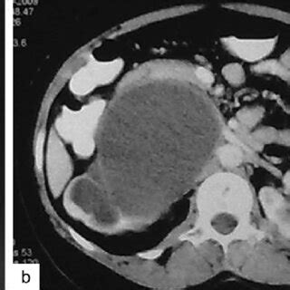 (a) Intravenous urogram. (b and c) Contrast enhanced CT scan showing a ...