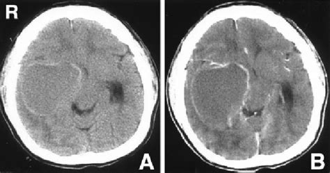 Figure 3 from Radiological features of germinoma arising from atypical ...