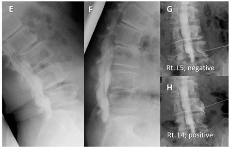 Medicina Free Full Text A Comparative Clinical Study Of Lateral