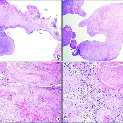 Final Soft Tissue Specimen Showing Squamous Cell Carcinoma Scc Lesion