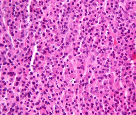 Plasmacytoma Solitary Bone Plasmacytoma Extramedullary Plasmacytoma