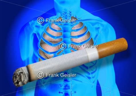 Medical Art Lunge COPD Und Lungenkrebs Durch Rauchen Medical Pictures