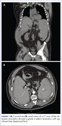 Atraumatic Splenic Rupture As An Initial Presentation Of Chronic