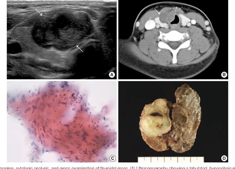 [pdf] Primary Neurilemmoma Of The Thyroid Gland Clinically Mimicking Malignant Thyroid Nodule