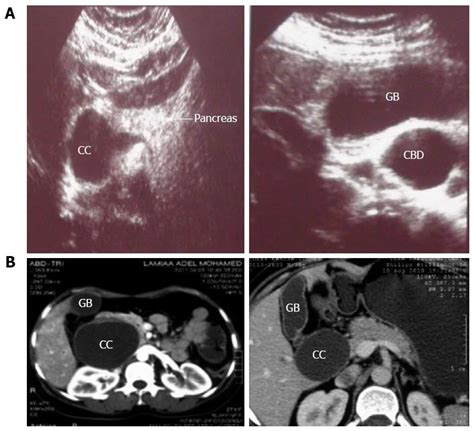 Diagnosis And Management Of Choledochal Cyst 20 Years Of Single Center Experience