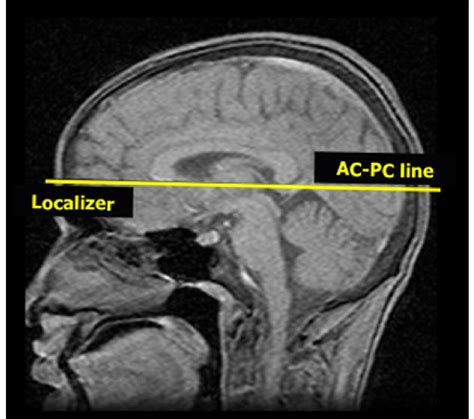 Head position during MRI acquisition. The anterior commissure-posterior ...