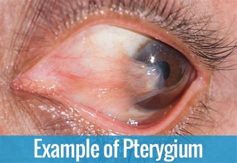 Pterygium Treatment NY2020