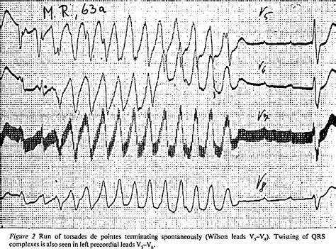 Figure From Torsades De Pointes Occurrence In Myocardial Ischaemia