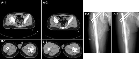 Hypofractionated Radiation Therapy For Progressive Heterotopic Ossification The Relationship