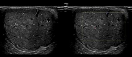 Epidermal inclusion cyst | Radiology Case | Radiopaedia.org