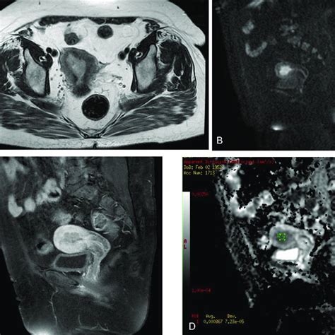 A 54 Year Old Woman With A Histopathologically Proven Endometrial Download Scientific Diagram