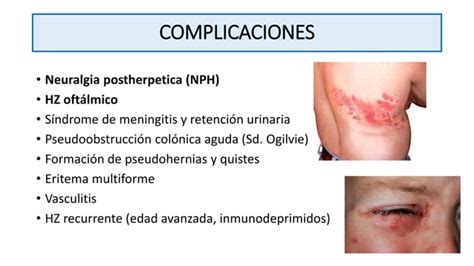 Herpes Zoster Ppt Ppt Descarga Gratuita