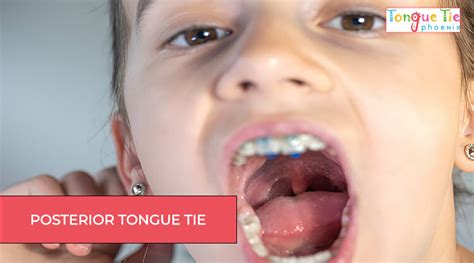 Posterior Tongue Tie Symptoms Complications And Treatment