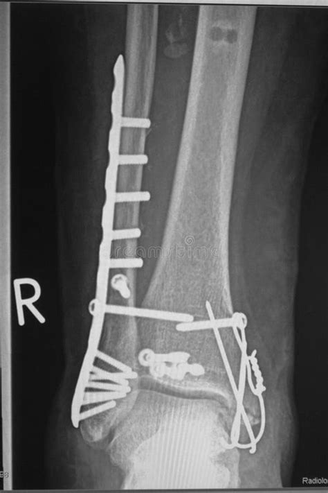 An X-ray Shows an Ankle Fracture after Surgery Stock Image - Image of ...