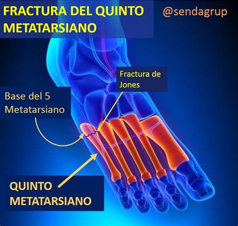 Fractura De La Base Del Quinto Metatarsiano O Fractura De Jones Sendagrup