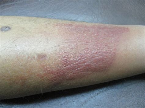 Bacterial Cellulitis Of The Leg