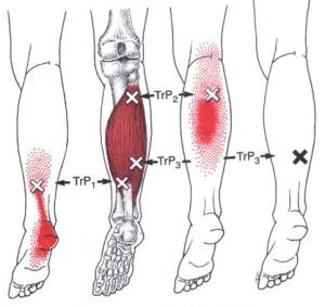 soleus injuries | Brian Schiff’s Blog