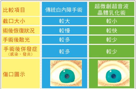 白內障手術 超微創超音波晶體乳化術 大學眼科