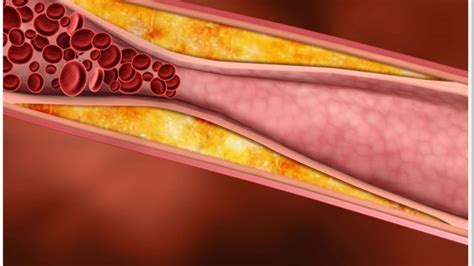 Arquivos doença arterial obstrutiva periférica Cirurgião Vascular