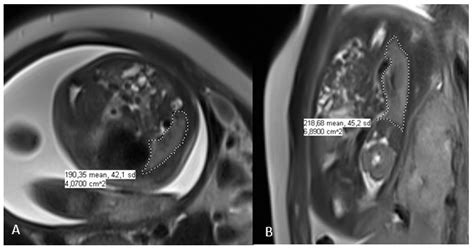 Jcm Free Full Text Fetal Lung Volume Appears To Predict Respiratory