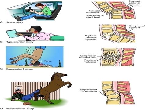 Neuro Spinal Cord Injuries Flashcards Quizlet