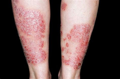 Plaque Psoriasis Arthritis Rash Legs Hot Sex Picture