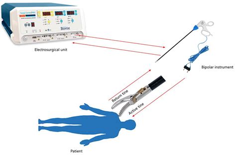 Monopolar Vs Bipolar Electrosurgery