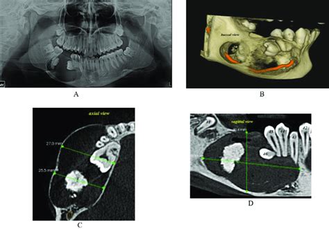 A Initial Panoramic Radiograph B Cbct Images Demonstrating The