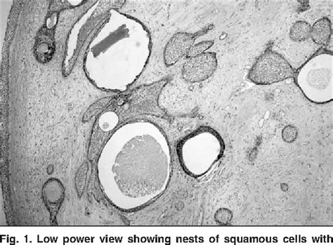 Figure 1 From Tubulo Squamous Polyp Of The Vagina Semantic Scholar