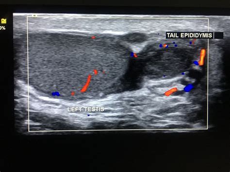 Epididymal Tail Tubercular Infection Diagnostic Medical Sonography