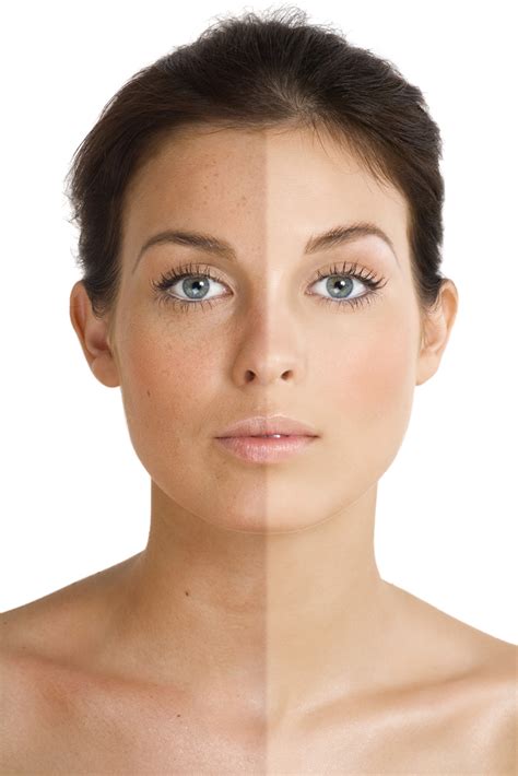 The Best Laser Skin Resurfacing Treatment For Sun Damaged Skin Laser