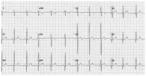 Gen Med Ekgs Flashcards Quizlet