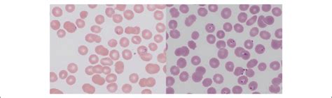 Left Babesia Microti In Peripheral Blood Smear Several Red Blood