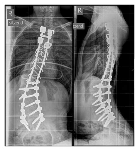 What You Need To Know About Spinal Stabilization Surgery Medical