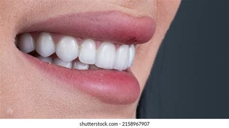 Press Ceramic Crowns Veneers Stock Photo 2158967907 Shutterstock