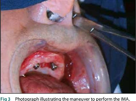 Figure 1 from The Use of Inferior Meatal Antrostomy to Decrease Sinusitis with the Placement of ...