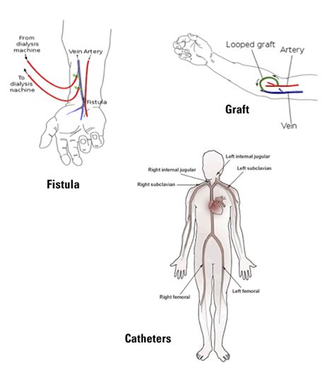 In Center Dialysis Centers For Dialysis Care