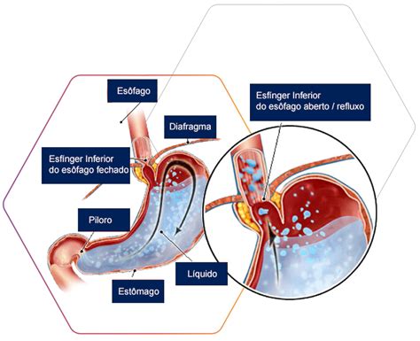 Cirurgia De Refluxo Dr Renar