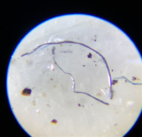 120x Suspected Parasitic Worms In Sputum On Curezone Image Gallery