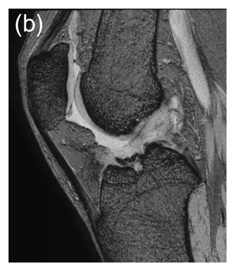 A Preoperative Magnetic Resonance Imaging MRI Showing No Rupture