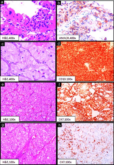 Immunohistochemical Expressions Of Renal Cell Tumors A Papillary