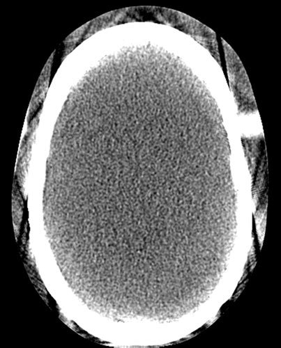 Artifacts In Ct Recognition And Avoidance Radiographics