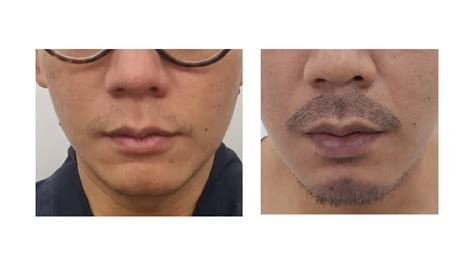 Mustache Transplant Glojas Hair Transplant