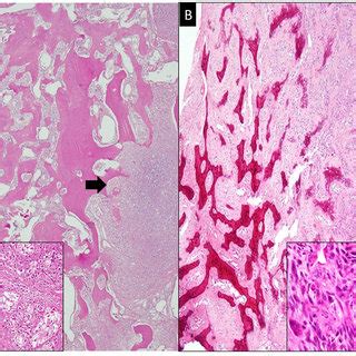 Dedifferentiated Component A Chondroblastic Osteosarcoma Tumor With