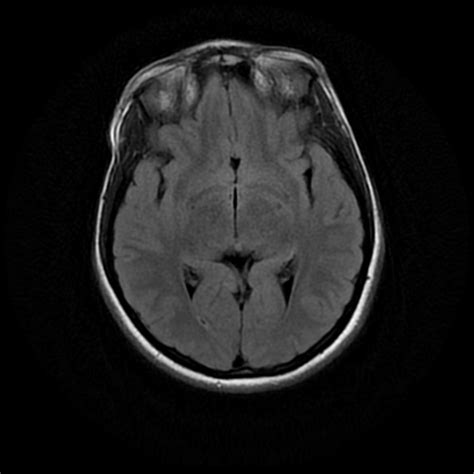 Intracranial Epidermoid Cyst Image