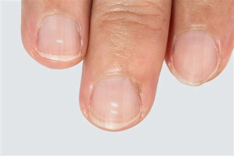 10 Disturbing Things Your Nails Reveal About Your Health Health