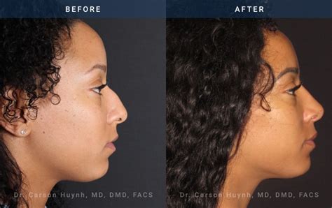 Rhinoplasty Case 1898 Radiance Surgery Aesthetic Medicine