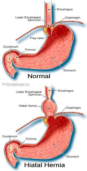 Hiatal Hernia