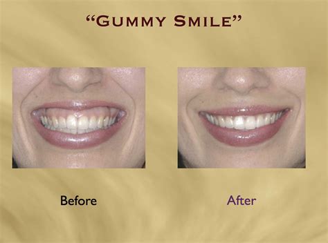 How To Fix A Gummy Smile A Comprehensive Guide To Restoring Your