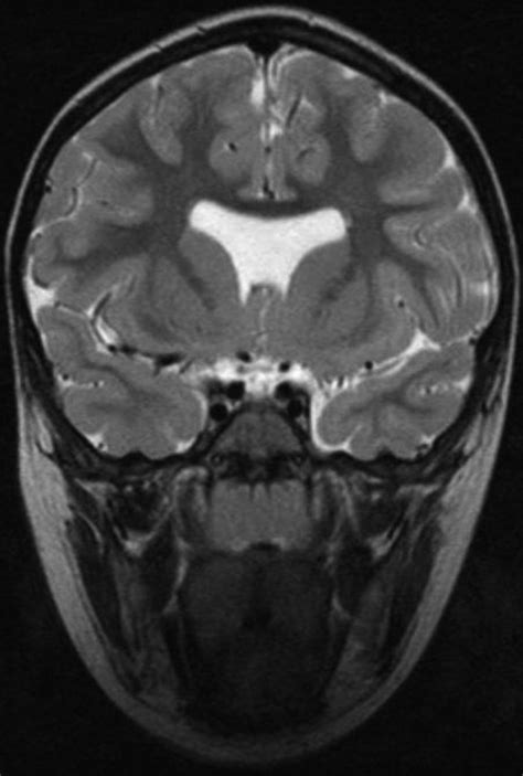 Septum Pellucidum Coronal